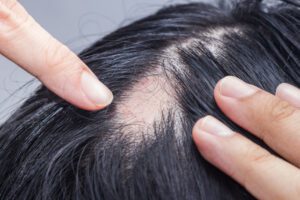 Czy istnieją jakieś przeciwwskazania do korzystania z systemu włosów?